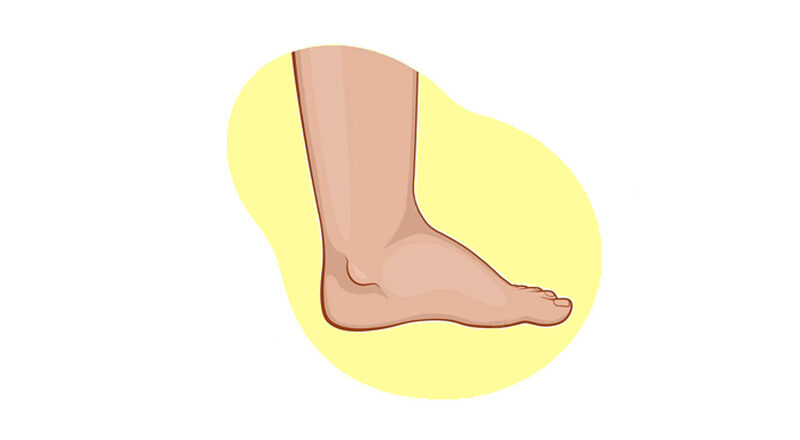 How to Treat Swollen Ankles Understanding and Solutions to This Problem